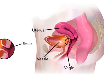 LA FISTULE OBSTETRICALE, une des plus graves complications de l’accouchement
