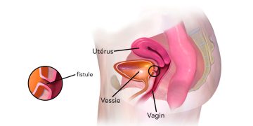 LA FISTULE OBSTETRICALE, une des plus graves complications de l’accouchement