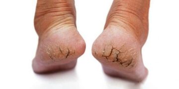 LES CREVASSES AUX TALONS
