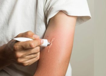 Comment soulager et guérir les brulures ?