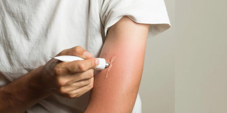 Comment soulager et guérir les brulures ?